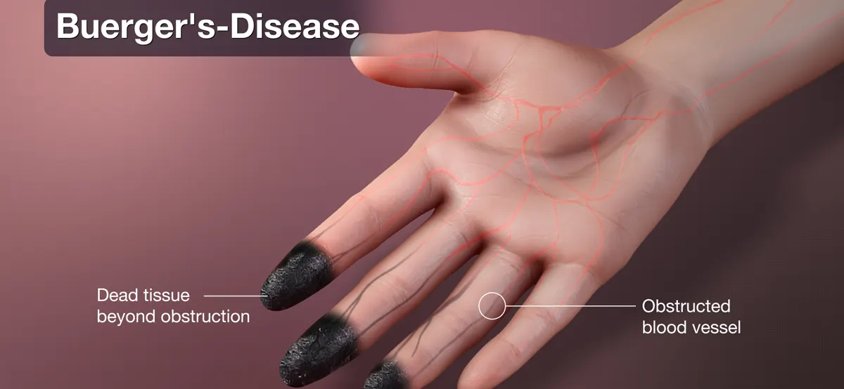 Buerger's disease