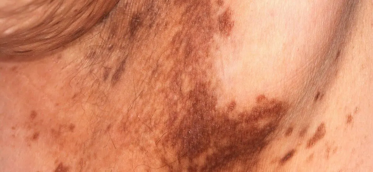 Systemic Lupus Erythematosus (SLE)