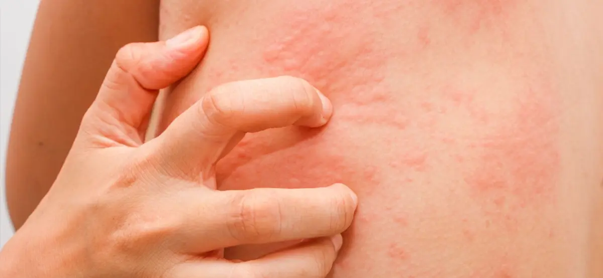 Mast Cell Activation Syndrome (MCAS)