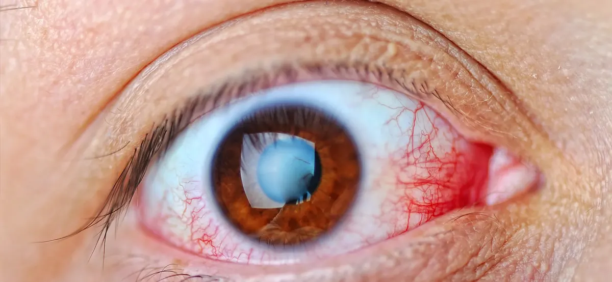 Sjögren's Syndrome