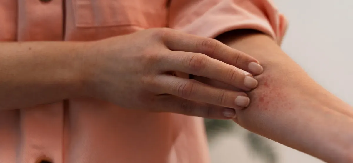 Systemic Lupus Erythematosus (SLE)
