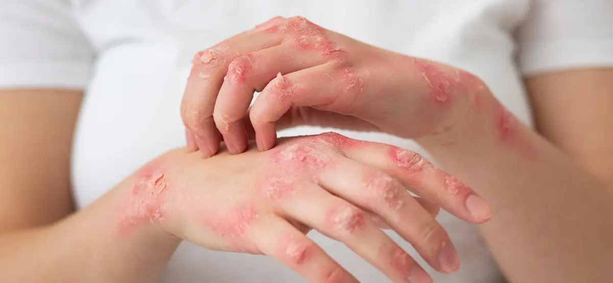 Urticaria (Hives)