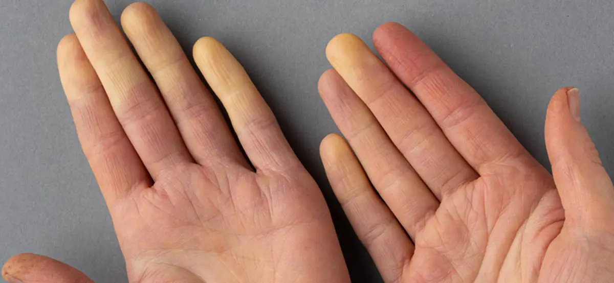 Raynaud's Phenomenon